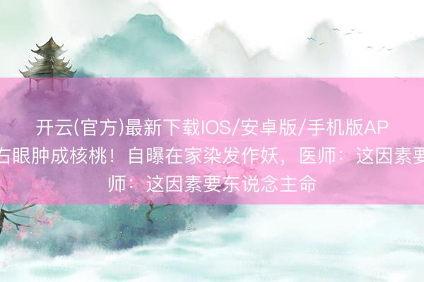 开云(官方)最新下载IOS/安卓版/手机版APP 尼格买提右眼肿成核桃！自曝在家染发作妖，医师：这因素要东说念主命